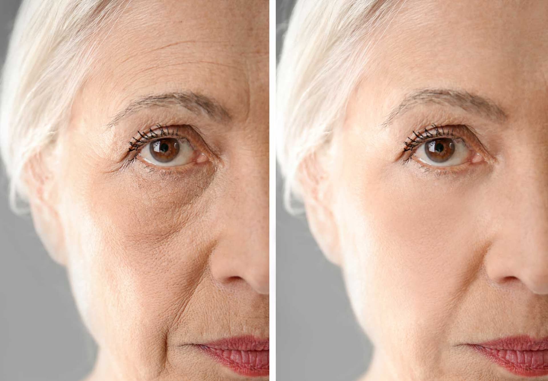 anti-wrinkle-1
