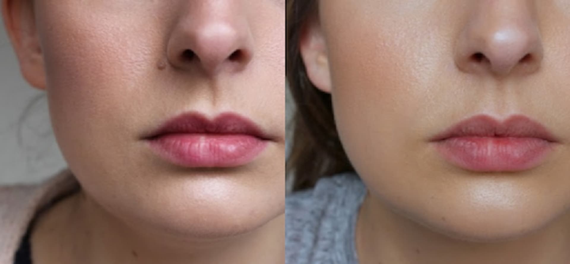 cosmetics-mole-removal-1