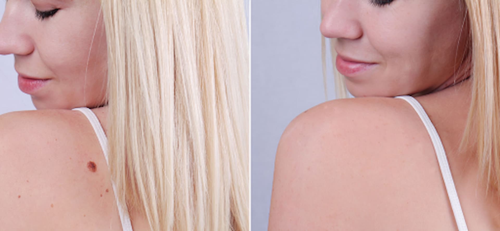 cosmetics-mole-removal-2