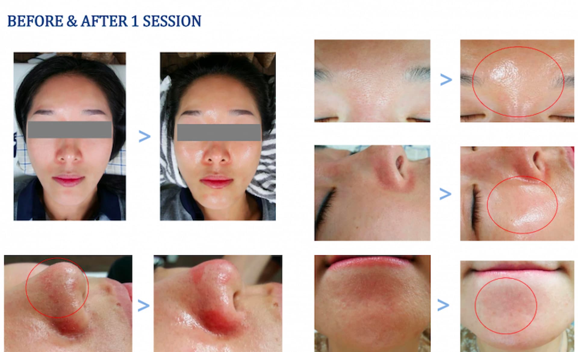 hydrafacial-6