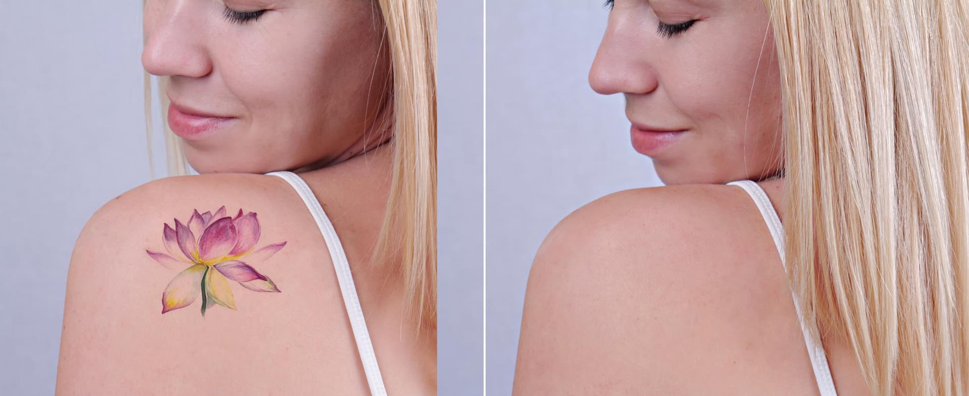 laser-tattoo-removal-1