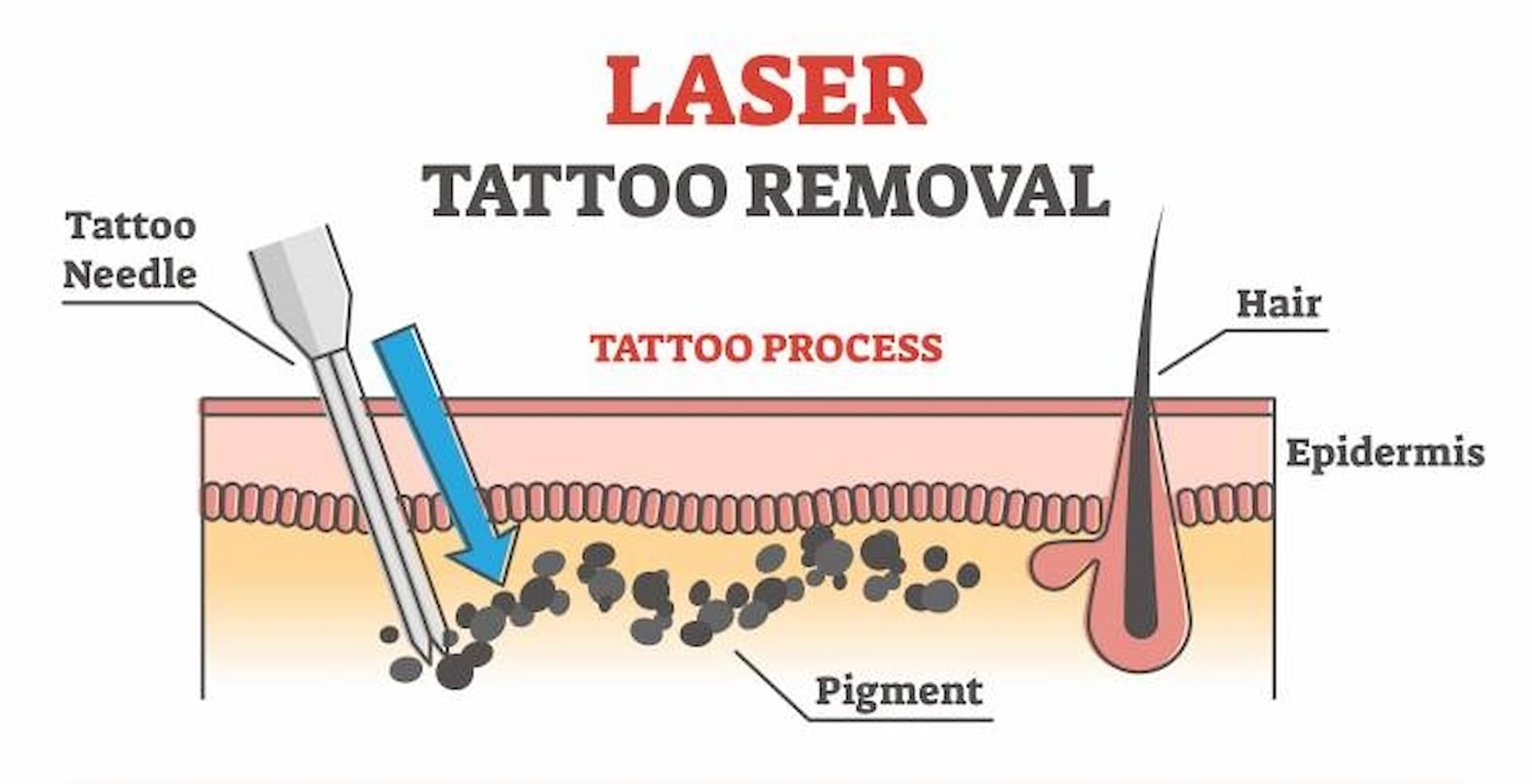 laser-tattoo-removal