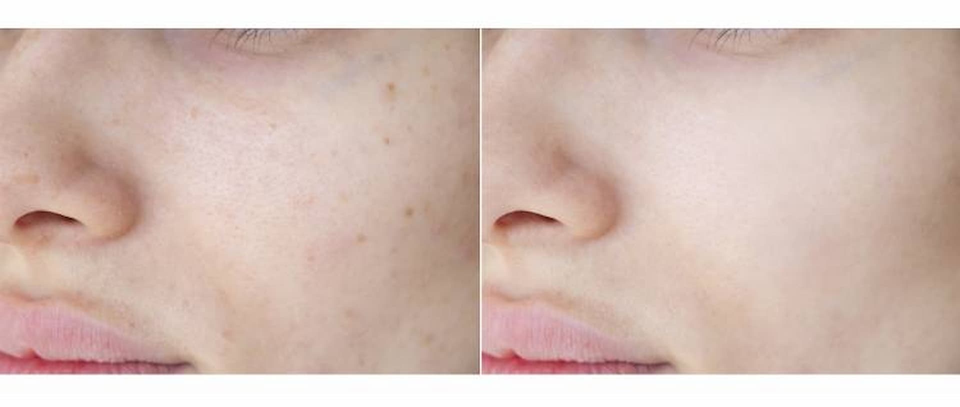 laser-toning-1