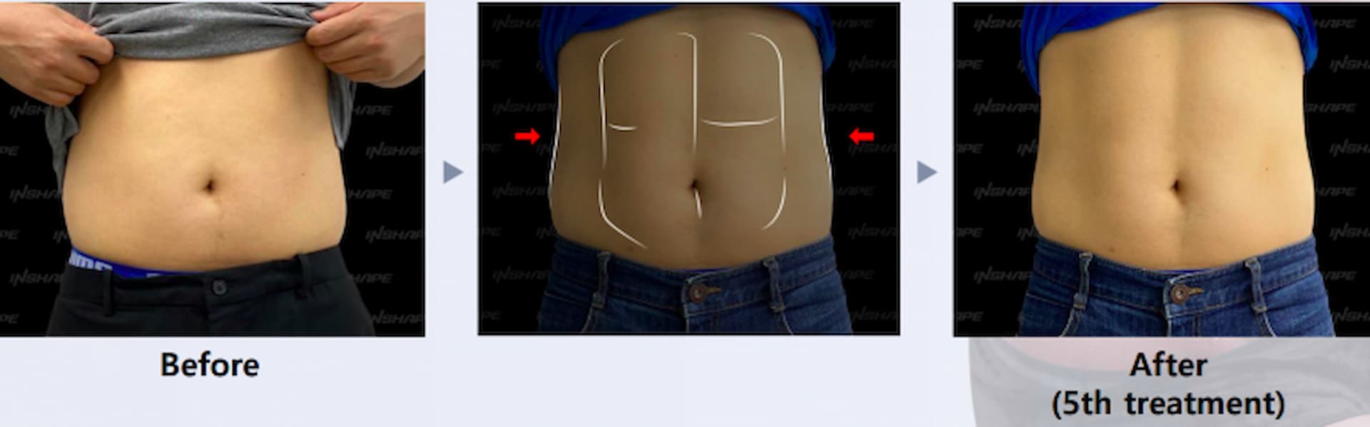 lipo-x-2