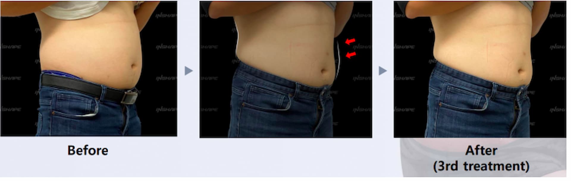 lipo-x-3