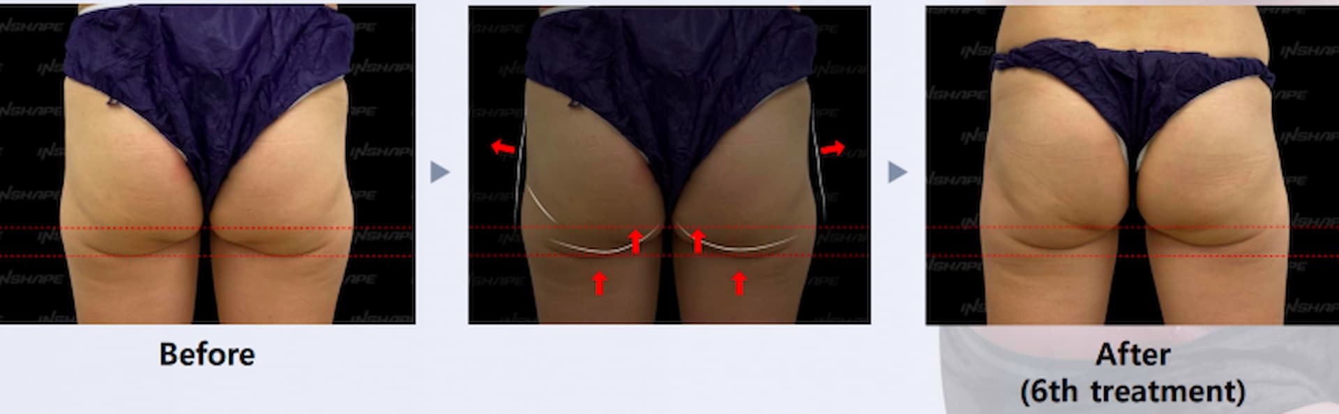 lipo-x-4