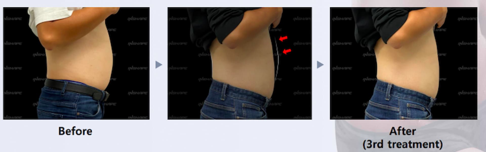 lipo-x-5