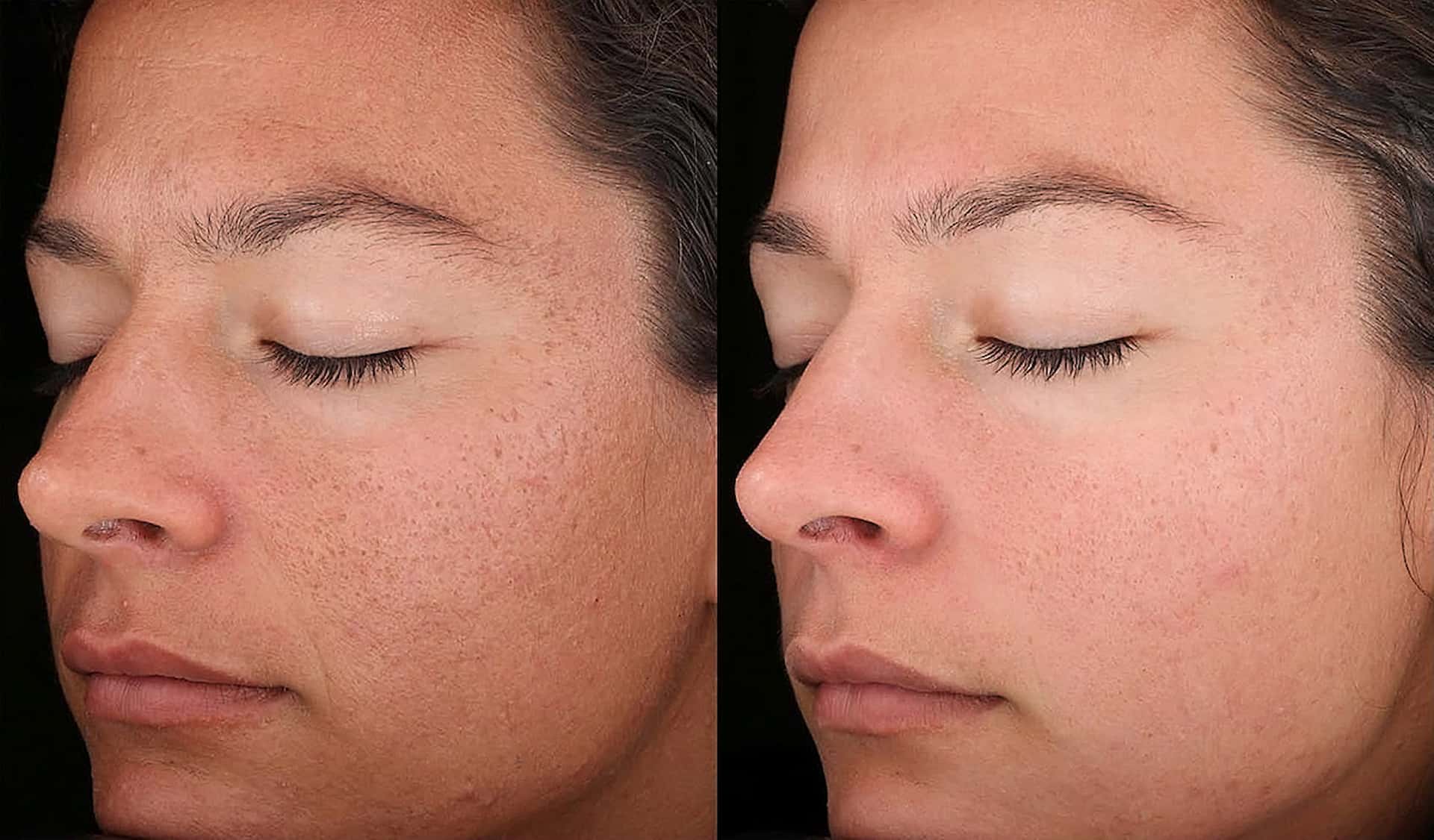 raffine-microneedling-2