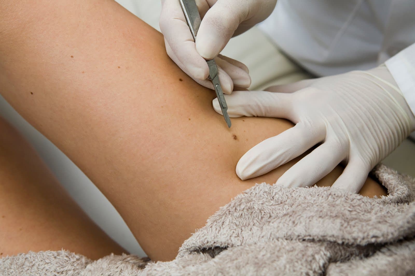 skin-tag-removal-1