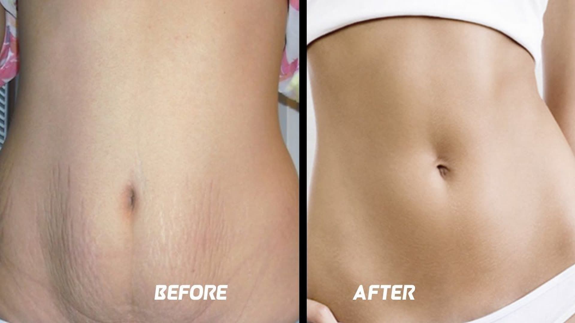 stretch-mark-removal-2