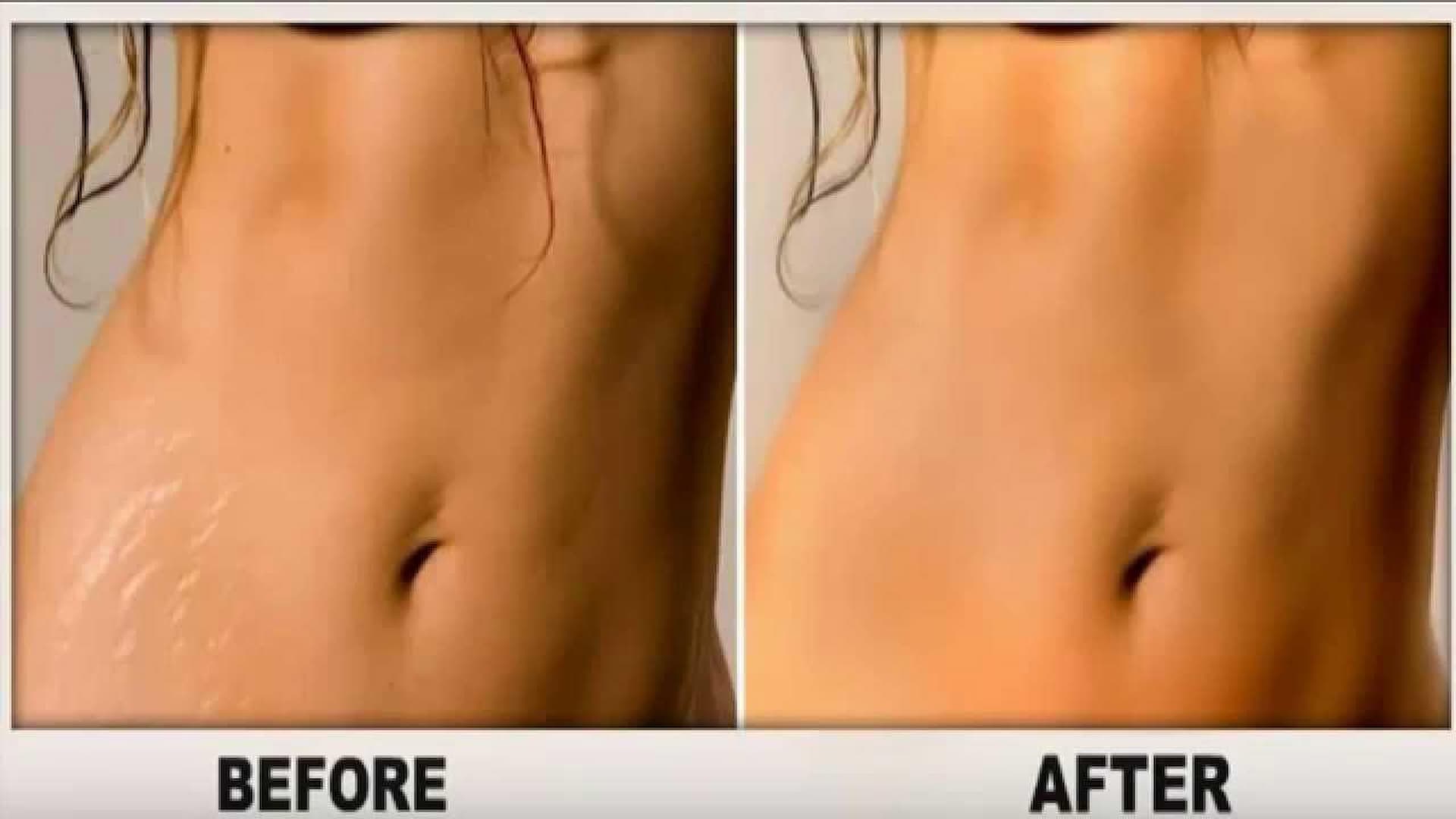 stretch-mark-removal-3