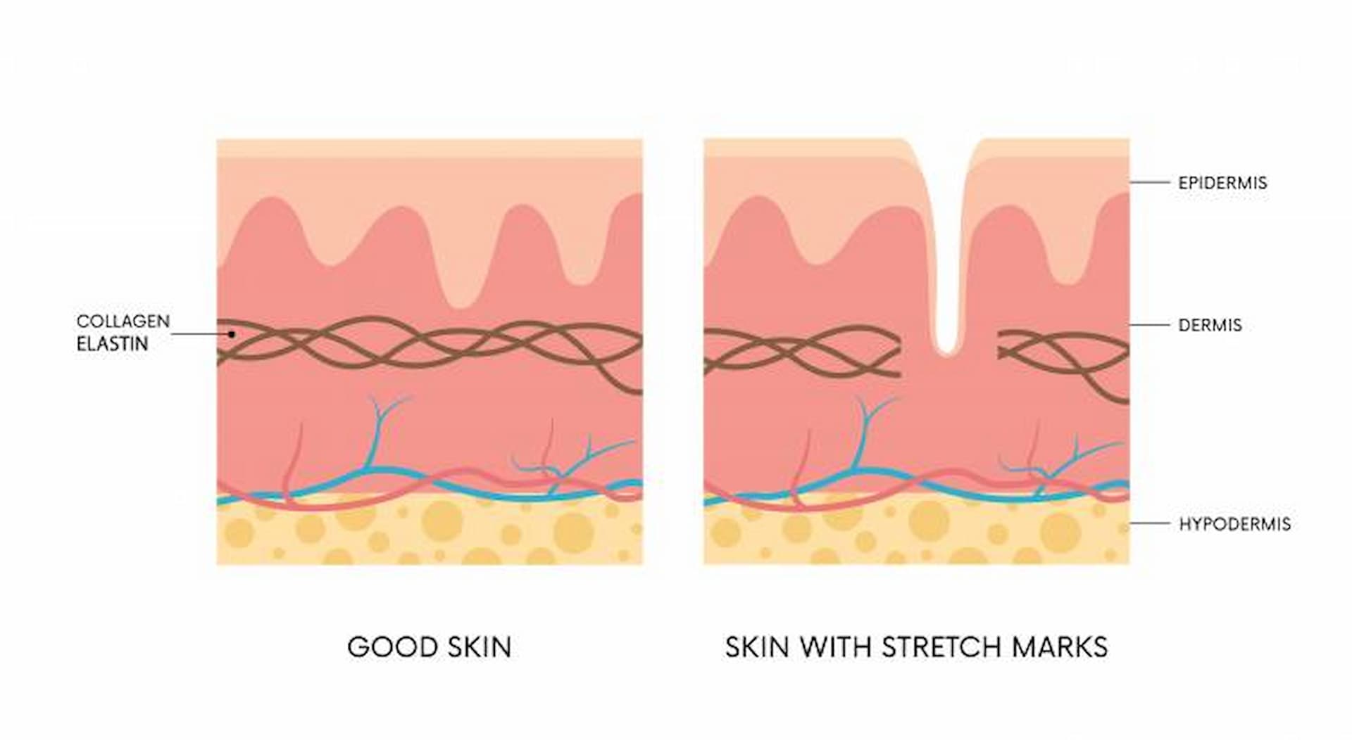 stretch-mark-removal