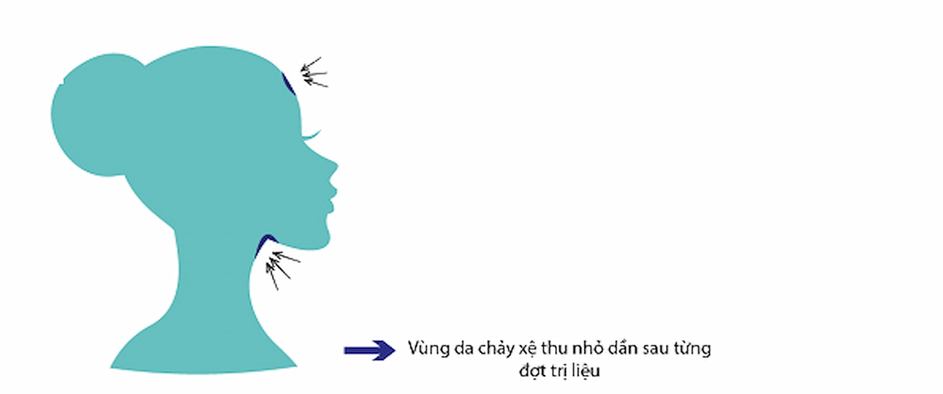 ulf-2